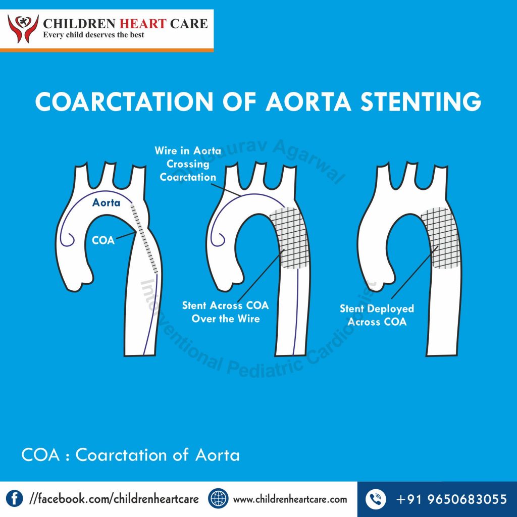 COARCTATION OF AORTA STENTING
