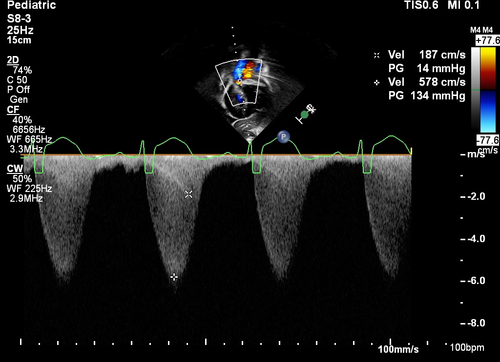 Pulmonary Valve Stenosis Echo