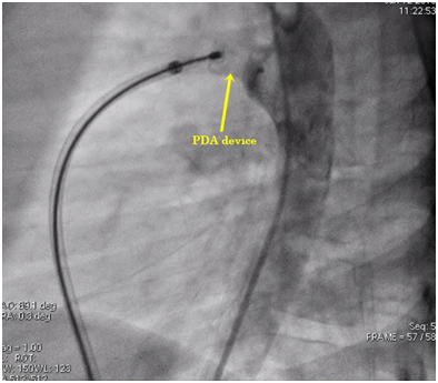 Best PDA Device Closure in Delhi