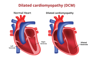 Dilated Cardiomyopathy (DCMP)