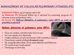 Management of Valvular Pulmonary Stenosis (PS)