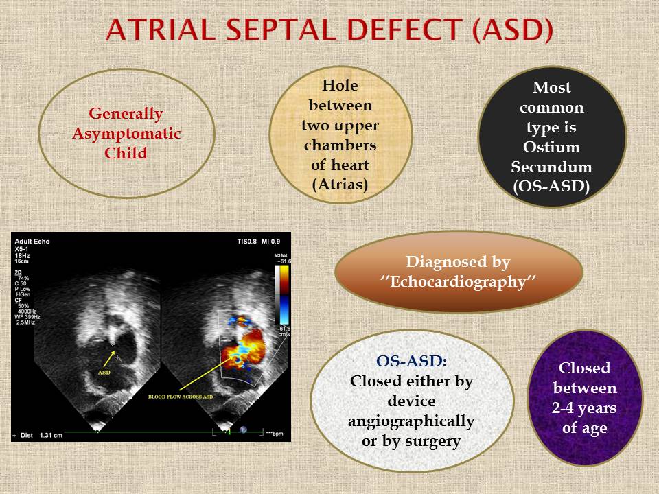 atrial septal defect types