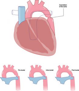 Coarctation of the Aorta (CoA) Symptoms & Surgery Options