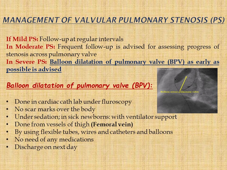 management of valvular pulmonary stenosis