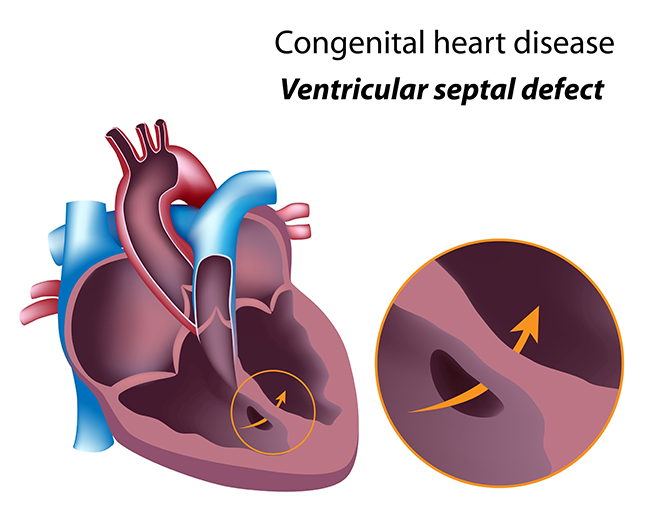 Device Closure Procedure, ASD, VSD, PDA