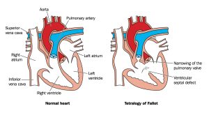 Tetralogy of Fallot Treatment : Dr. Gaurav Agrawal