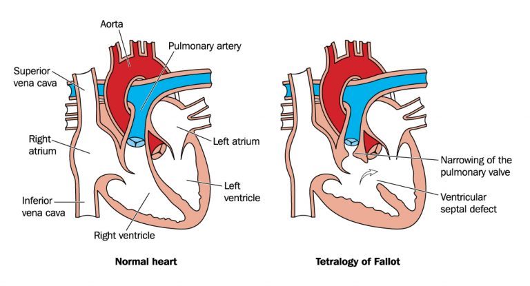 Tetralogy of Fallot Treatment : Dr. Gaurav Agrawal