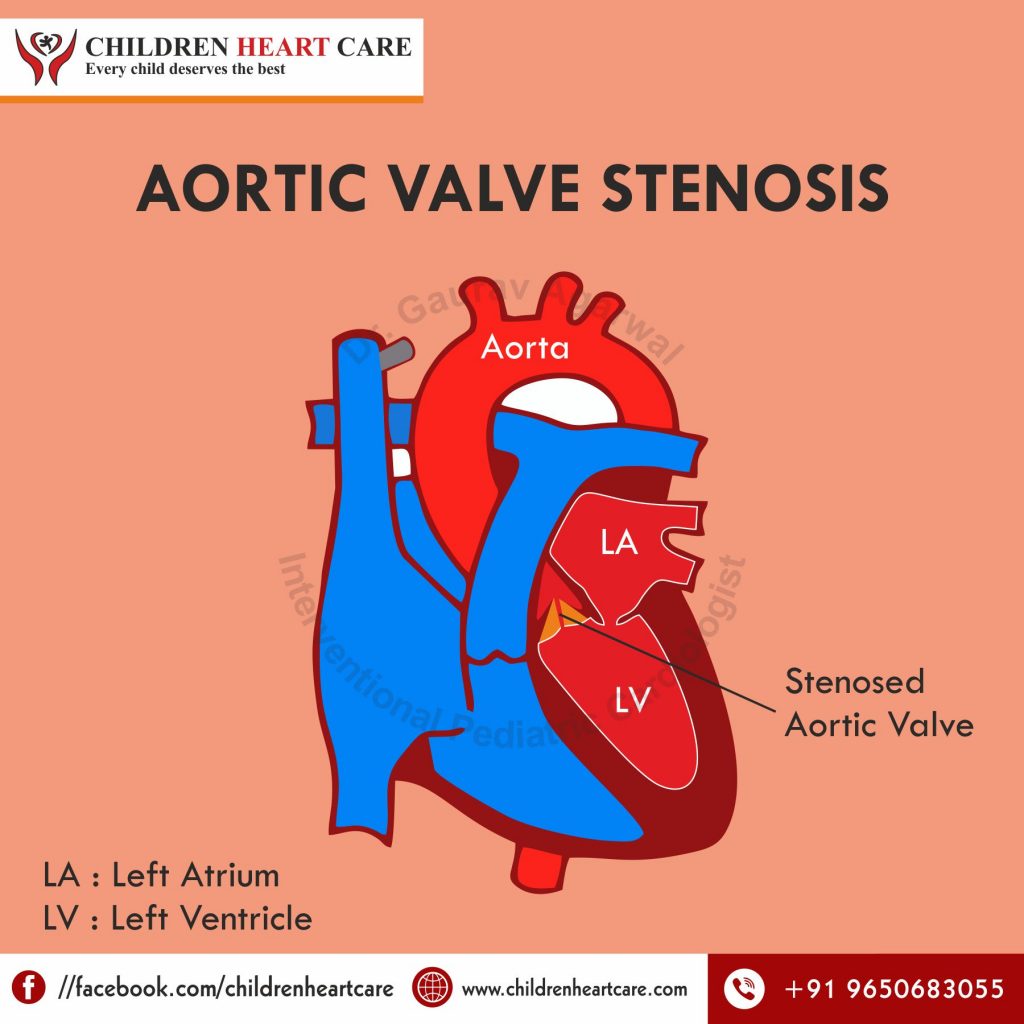 AORTIC VALVE STENOSIS