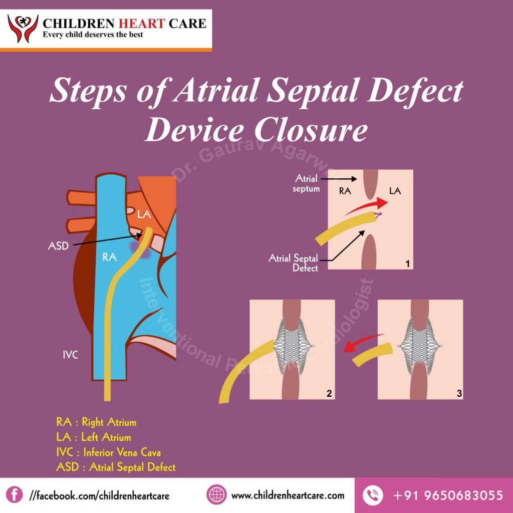 ASD DEVICE CLOSURE STEPS