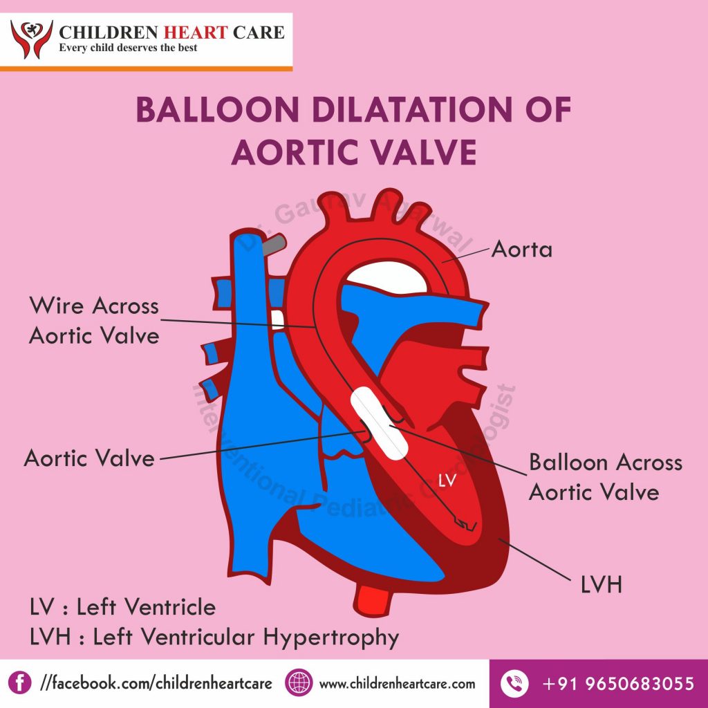 BALLOON DILATATION OF AORTIC VALVE