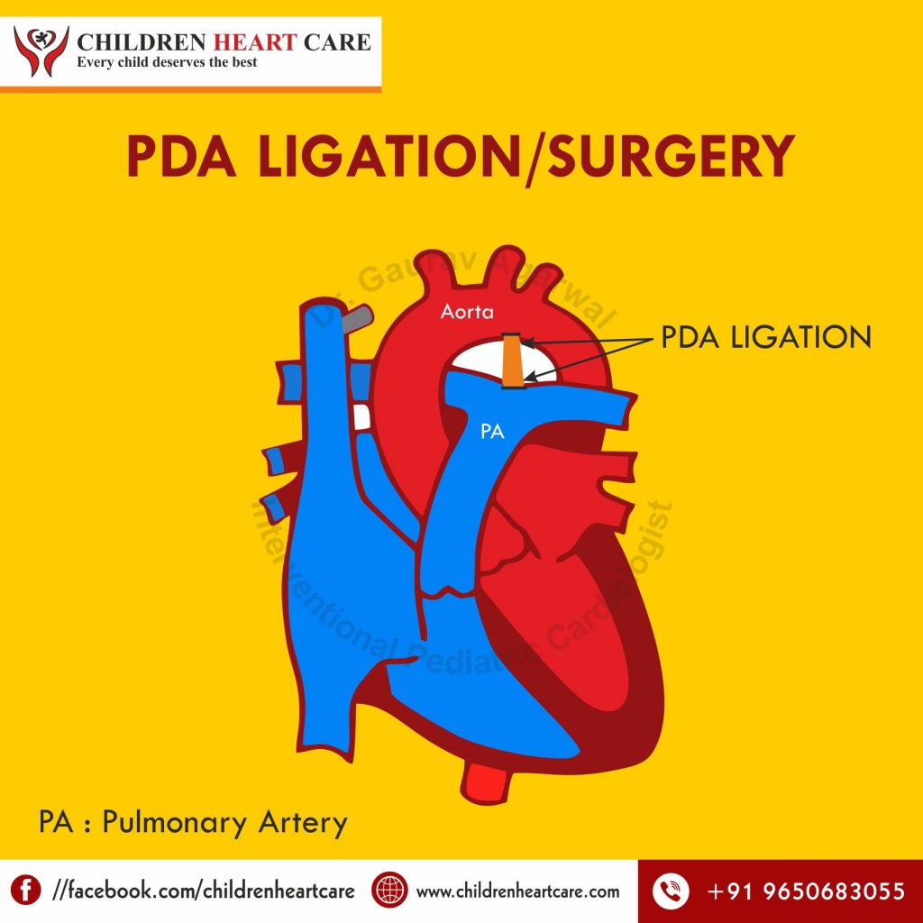 PDA LIGATION SURGERY