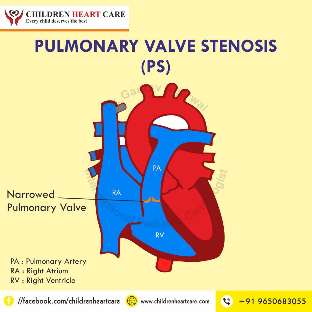 Pulmonary Stenosis Treatment in Delhi : Dr. Gaurav Agrawal