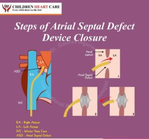 Treatment of Atrial Septal Defect (ASD) – Blog