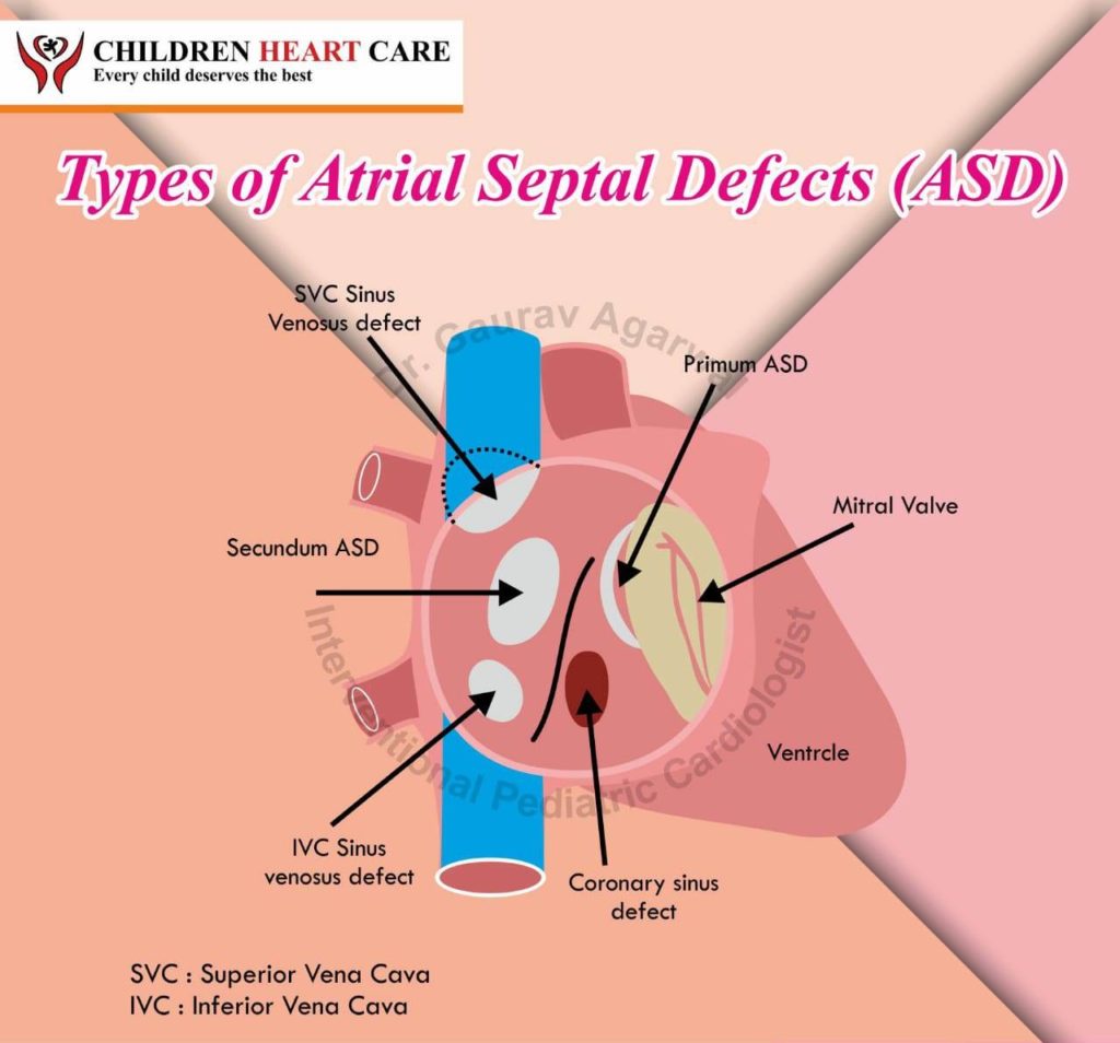 Atrial Septal Defect Asd Blog Dr Gaurav Agrawal 8728