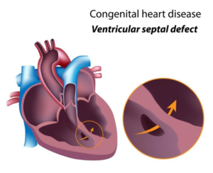 Ventricular Septal Defect (VSD) – Blog