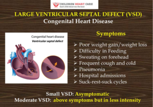 Symptoms Due to Ventricular Septal Defect (VSD)