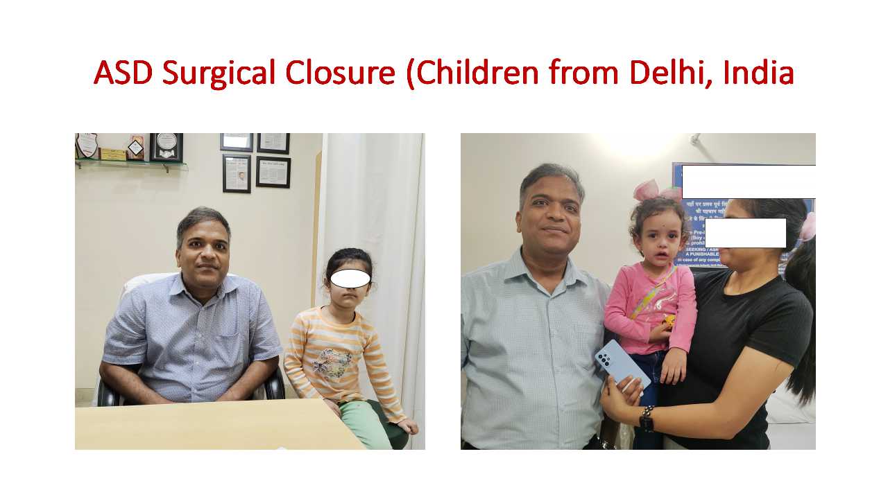 Atrial Septal Defect (ASD) Surgical Closure