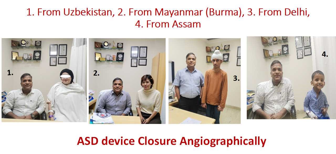 ASD (Atrial Septal Defect) Device Closure (Angiographically without Heart Surgery)